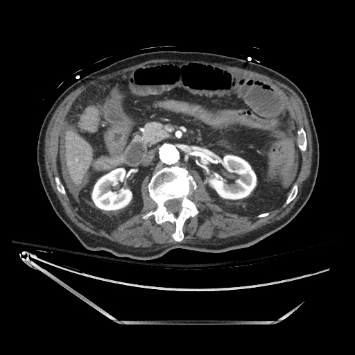 Closed loop obstruction due to adhesive band, resulting in small bowel ischemia and resection (Radiopaedia 83835-99023 B 61).jpg