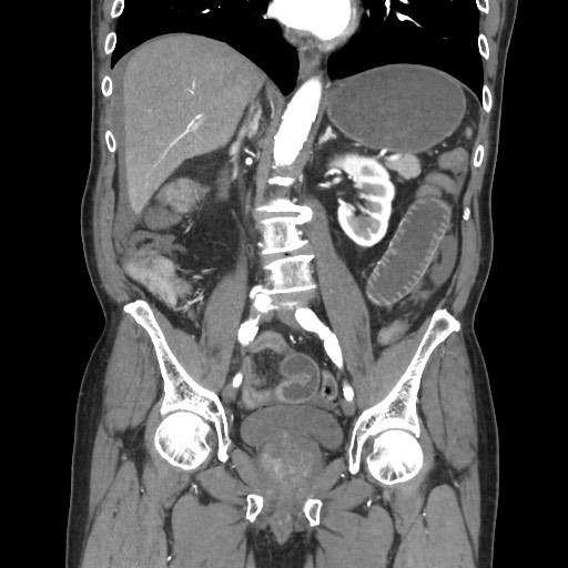 Closed loop obstruction due to adhesive band, resulting in small bowel ischemia and resection (Radiopaedia 83835-99023 C 70).jpg