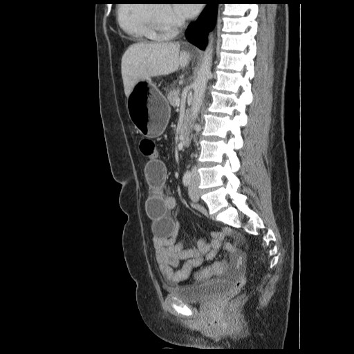 Closed loop small bowel obstruction (Radiopaedia 65403-74451 C 50).jpg