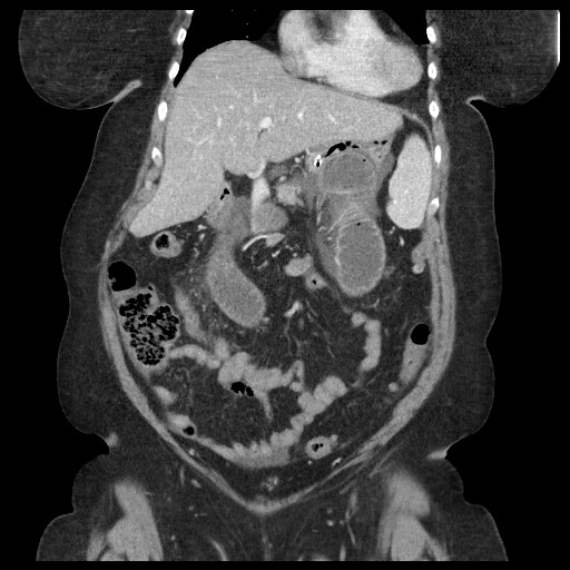 Closed loop small bowel obstruction - internal hernia (Radiopaedia 65402-74450 B 39).jpg