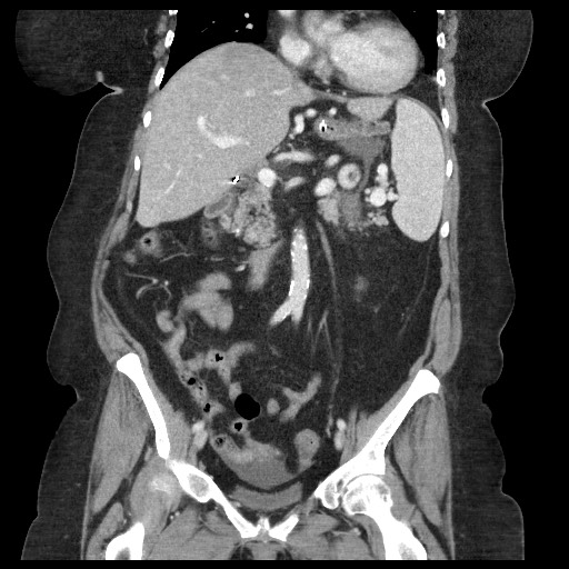 Closed loop small bowel obstruction - internal hernia (Radiopaedia 65402-74450 B 55).jpg