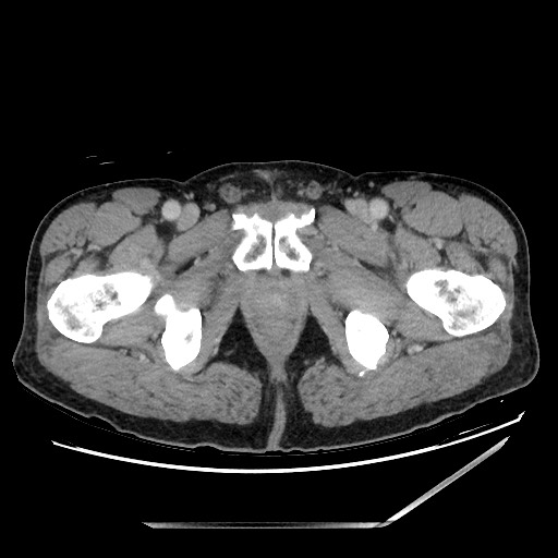Closed loop small bowel obstruction - omental adhesion causing "internal hernia" (Radiopaedia 85129-100682 A 175).jpg
