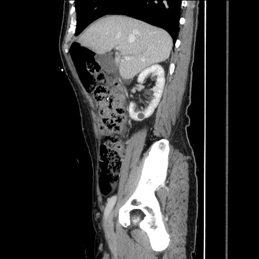 Closed loop small bowel obstruction - omental adhesion causing "internal hernia" (Radiopaedia 85129-100682 C 63).jpg