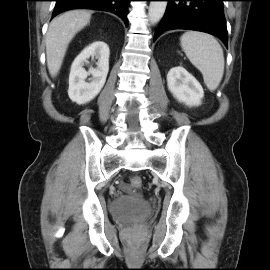 Closed loop small bowel obstruction due to adhesive band - U-shaped loop (Radiopaedia 83829-99012 B 36).jpg
