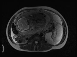 Closed loop small bowel obstruction in pregnancy (MRI) (Radiopaedia 87637-104031 D 3).jpg