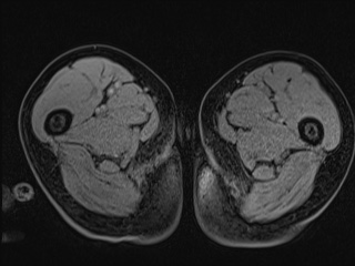File:Closed loop small bowel obstruction in pregnancy (MRI) (Radiopaedia 87637-104031 G 51).jpg