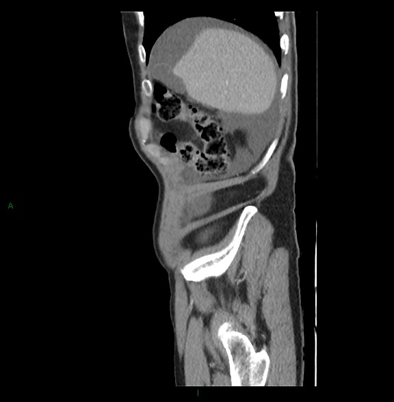 Closed loop small bowel obstruction with ischemia (Radiopaedia 84180-99456 C 15).jpg