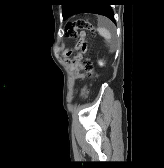 Closed loop small bowel obstruction with ischemia (Radiopaedia 84180-99456 C 78).jpg