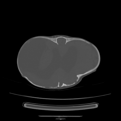 Cloverleaf skull (Radiopaedia 91901-109710 Axial bone window 106).jpg