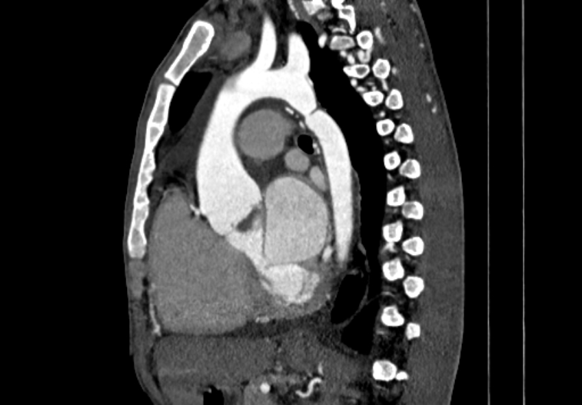 Coarctation of aorta with aortic valve stenosis (Radiopaedia 70463-80574 B 80).jpg
