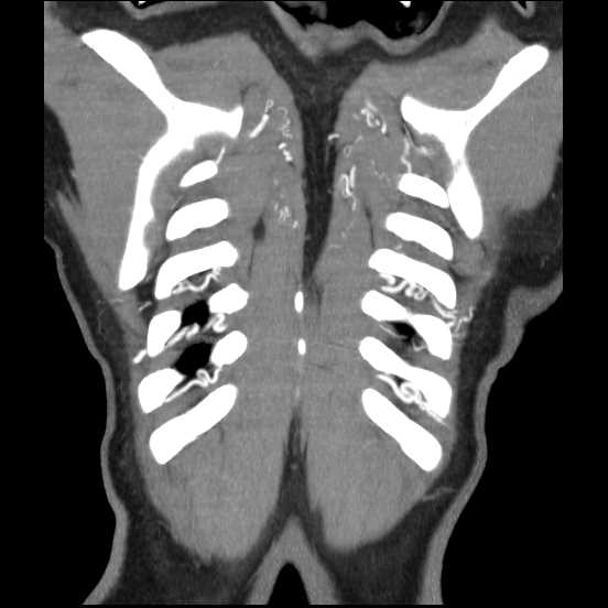 Coarctation of the aorta (Radiopaedia 67609-77010 B 6).jpg
