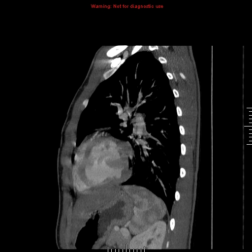 File:Coarctation of the aorta (Radiopaedia 9434-10118 B 45).jpg