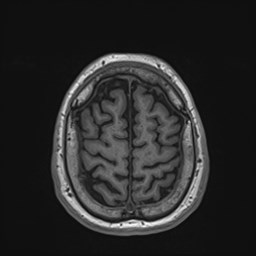 Cochlear incomplete partition type III associated with hypothalamic hamartoma (Radiopaedia 88756-105498 Axial T1 165).jpg