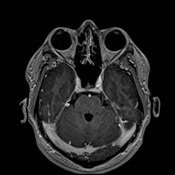 Cochlear incomplete partition type III associated with hypothalamic hamartoma (Radiopaedia 88756-105498 Axial T1 C+ 71).jpg