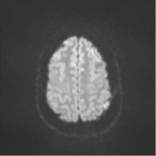 Colloid cyst (Radiopaedia 44510-48181 Axial DWI 51).png