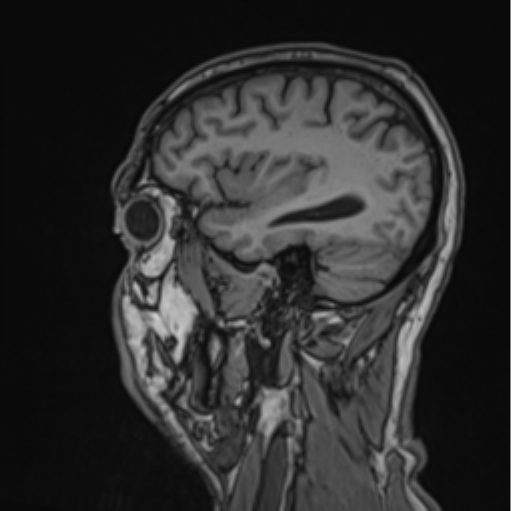 File:Colloid cyst of the third ventricle (Radiopaedia 86571-102662 Sagittal T1 20).png
