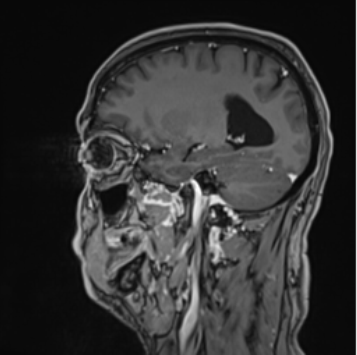 Colloid cyst of the third ventricle (Radiopaedia 86571-102662 Sagittal T1 C+ 25).png
