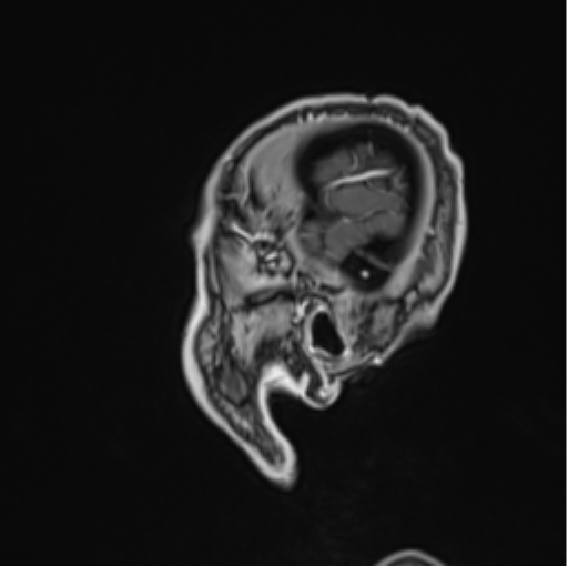Colloid cyst of the third ventricle (Radiopaedia 86571-102662 Sagittal T1 C+ 7).png