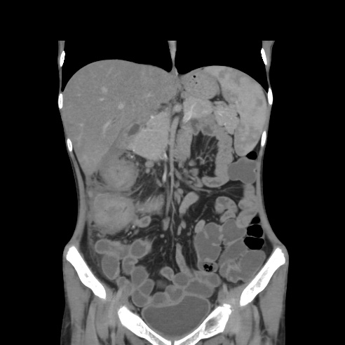 File:Colocolic fistula - Crohn disease (Radiopaedia 57063-63955 B 18).jpg