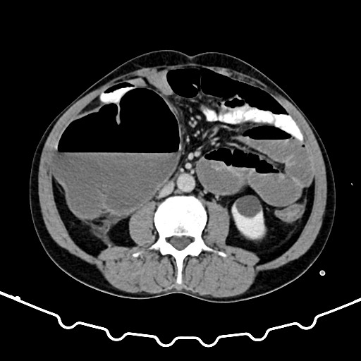 File:Colocolic intussusception due to large lipoma (Radiopaedia 68773-78482 A 94).jpg