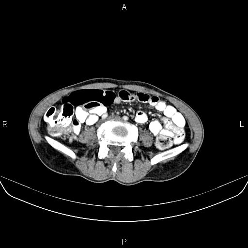 Colon adenocarcinoma - hepatic flexure (Radiopaedia 85635-101395 A 58).jpg
