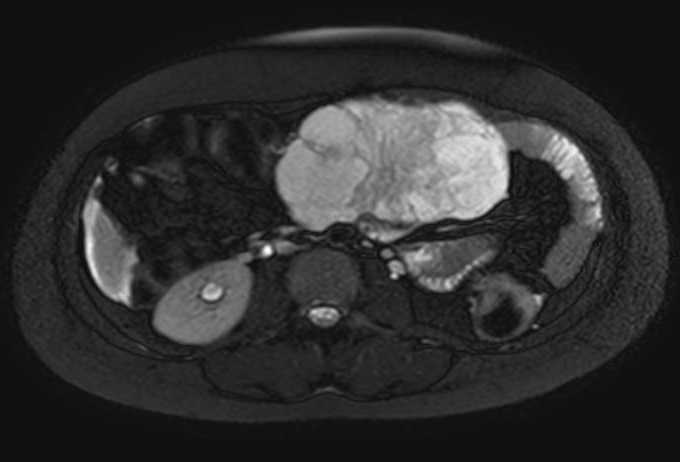 Colon adenocarcinoma with Krukenberg tumors, advanced pregnancy (Radiopaedia 67279-76645 Axial T2 SPAIR 44).jpg