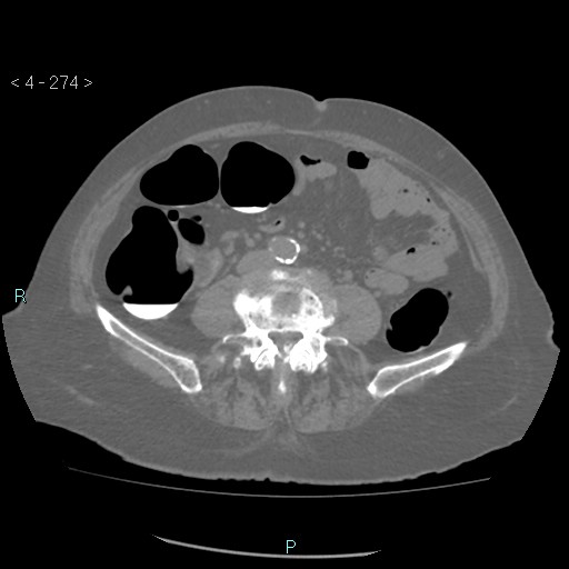 Colonic lipomas (Radiopaedia 49137-54244 Axial bone window 122).jpg