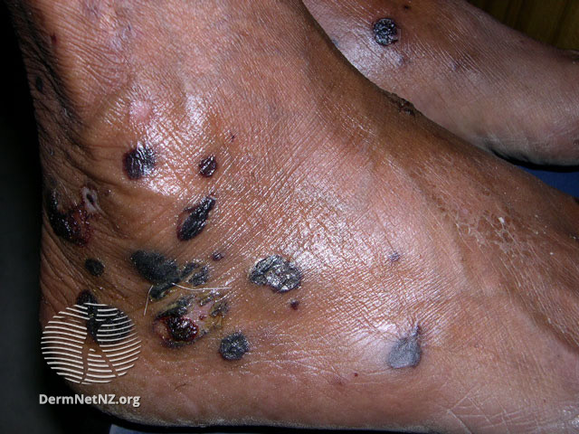File:Epidermolysis bullosa acquisita (DermNet NZ immune-eba-feet).jpg