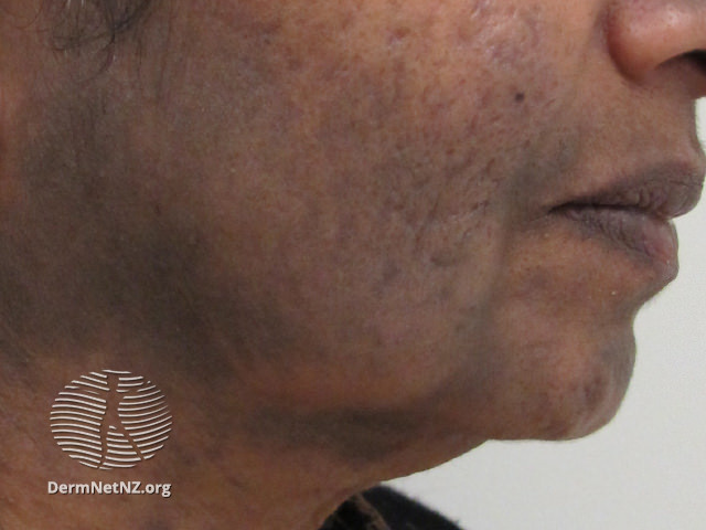 File:Lichen planus pigmentosus of face (DermNet NZ scaly-lp-pigmentosus1).jpg