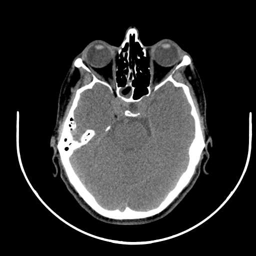 File:Nasopharyngeal carcinoma - infiltrating the clivus (Radiopaedia 62583-70875 Axial non-contrast 4).jpg