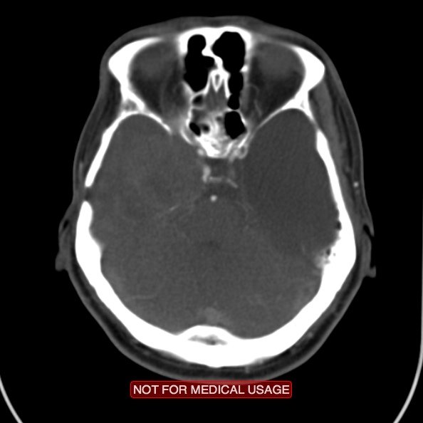 File:Nasopharyngeal carcinoma recurrence - skull base destruction (Radiopaedia 29107-29491 A 2).jpg