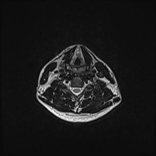 File:Nasopharyngeal carcinoma with perineural spread (Radiopaedia 55030-61380 Axial T2 61).jpg