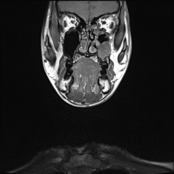Nasopharyngeal carcinoma with skull base invasion (Radiopaedia 53415-59485 Coronal T1 32).jpg