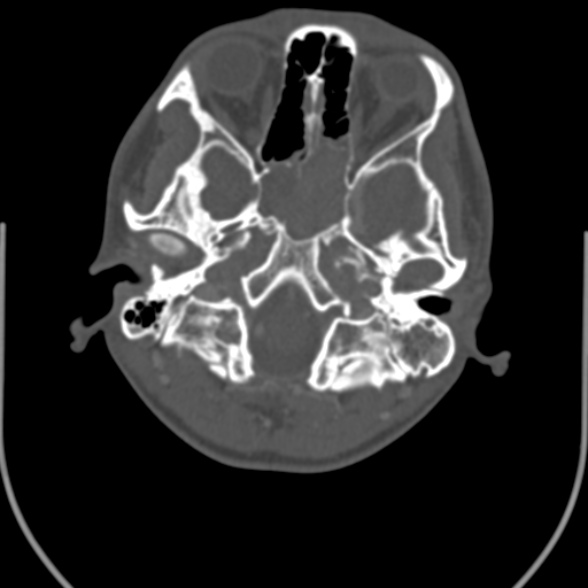Nasopharyngeal carcinoma with skull base invasion (Radiopaedia 53415-59705 Axial bone window 22).jpg