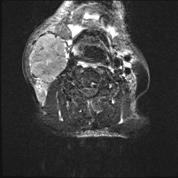 File:Nasopharyngeal carcinoma with skull base invasion (Radiopaedia 59258-66600 Axial T2 fat sat 4).jpg
