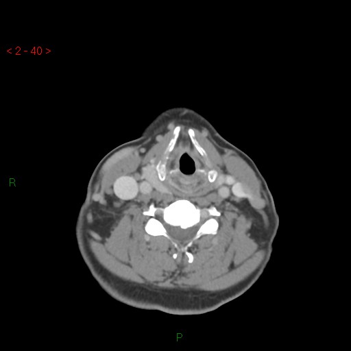 File:Nasopharyngeal lymphoma (Radiopaedia 54235-60433 A 10).jpg