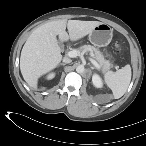 File:Necrotizing pancreatitis with acute necrotic collections (Radiopaedia 38829-41012 B 27).png
