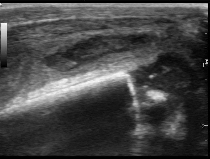 File:Neonatal knee septic arthritis (Radiopaedia 13358-13360 C 1).jpg