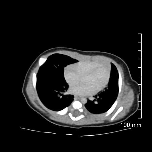 File:Neonatal neuroblastoma (Radiopaedia 56651-63438 Axial non-contrast 4).jpg