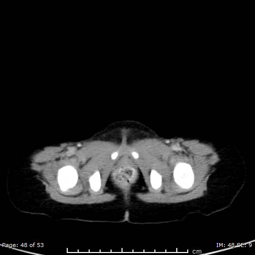Nephroblastomatosis (Radiopaedia 41934-44935 A 48).jpg