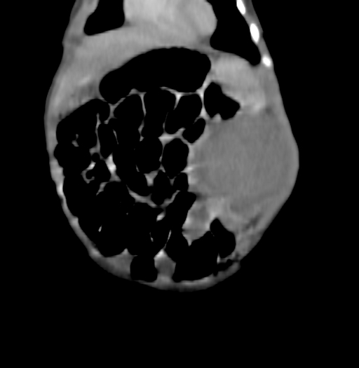 Nephroblastomatosis (Radiopaedia 71294-81607 B 78).jpg