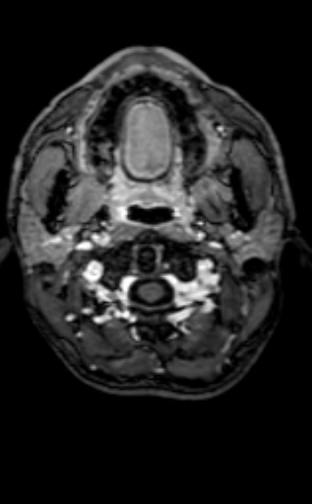Neuro-Behçet disease (Radiopaedia 90112-107294 Axial T1 C+ 208).jpg