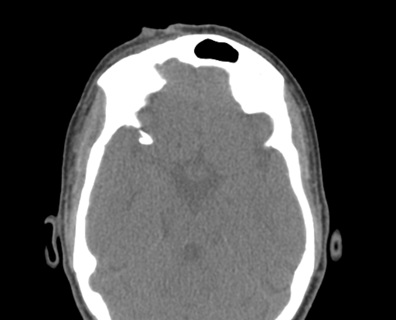 Neurofibromatosis type 1- orbital manifestations (Radiopaedia 49391-54511 Axial non-contrast 63).jpg