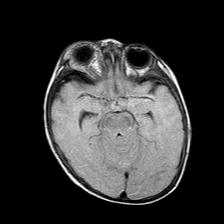 File:Neurofibromatosis type 1 (Radiopaedia 30089-30671 Axial FLAIR 9).jpg