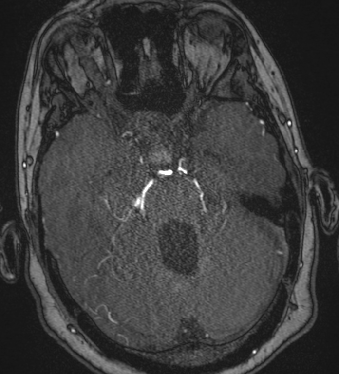 Neurofibromatosis type 1 - head and neck - CNS manifestations (Radiopaedia 49910-55188 Axial MRA 26).png