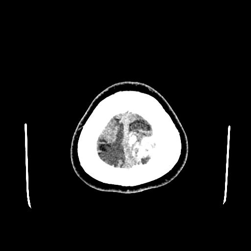 File:Neurofibromatosis type 2 (Radiopaedia 25389-25637 Axial C+ 98).jpg