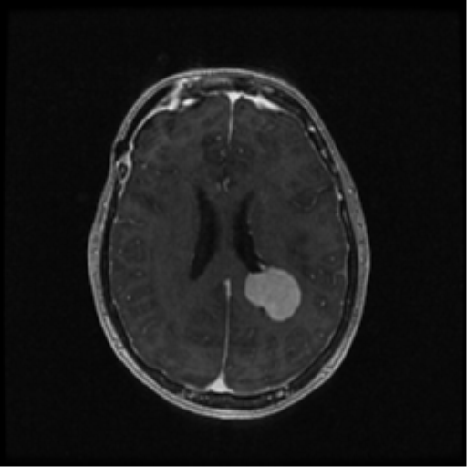Neurofibromatosis type 2 (Radiopaedia 45229-49244 Axial T1 C+ 76).png