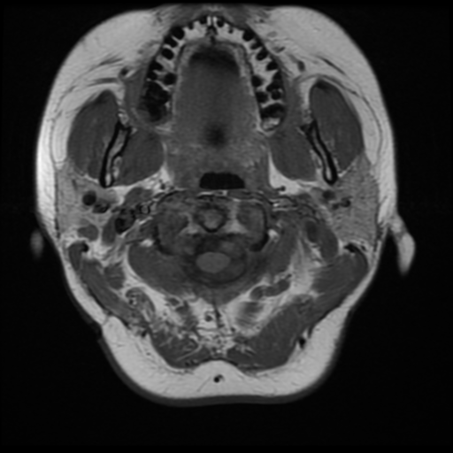 File:Neurofibromatosis type 2 (Radiopaedia 45229-49251 Axial T1 2).png