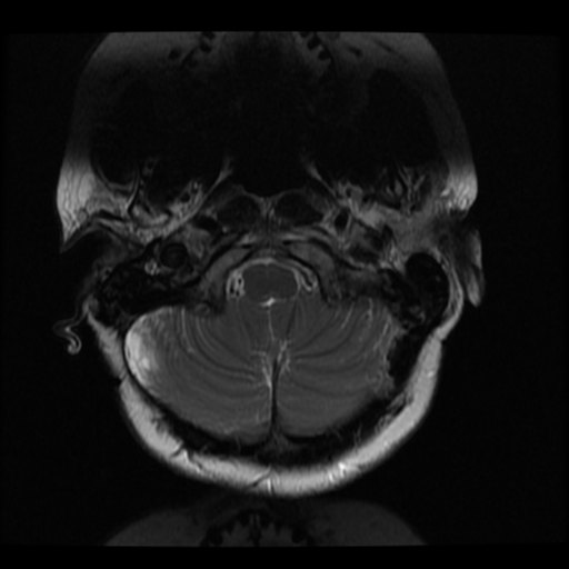 File:Neurofibromatosis type 2 (Radiopaedia 45229-49252 Axial T2 28).png