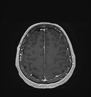 Neurofibromatosis type 2 (Radiopaedia 79097-92049 Axial T1 C+ 156).jpg